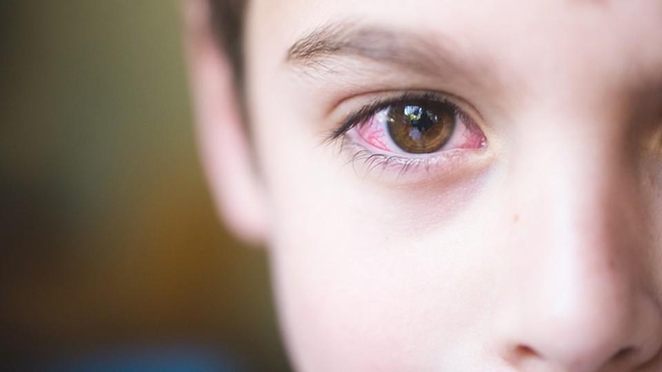Czerwone Oczy U Dziecka Jakie Są Przyczyny Leczenie Tvn Zdrowie Tvn Zdrowie 9868