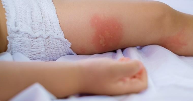Dziecko zatopowym zapaleniem skóry w pieluszce. Zbliżenie na odczyn alergiczny.