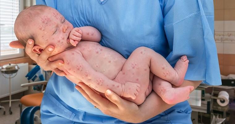 noworodek z czerwonymi plamkami na całym ciele trzymany na rekach u lekarza 