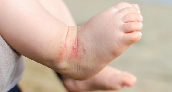Skóra atopowa – jak pielęgnować atopową skórę? Skóra atopowa u niemowląt i u dzieci