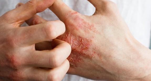 Nie traktuj łuszczycy powierzchownie – to nie tylko choroba skóry