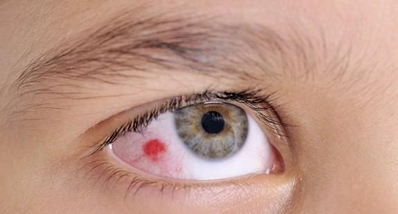 Czerwona plamka na oku. Przyczyny i leczenie