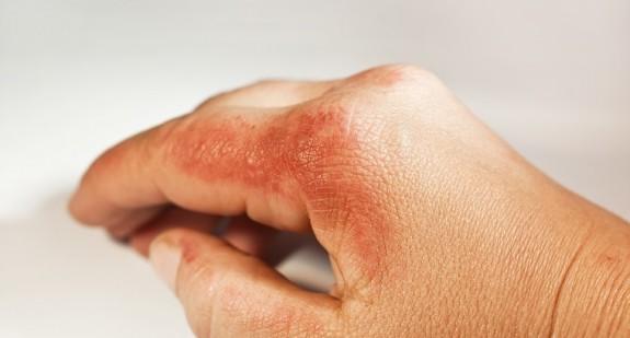 Alergia skórna – przyczyny alergii skórnej, objawy i metody leczenia