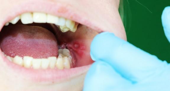 GIF wycofał z obrotu lek stosowany w leczeniu infekcji jamy ustnej. Dlaczego preparat znika z aptek? 