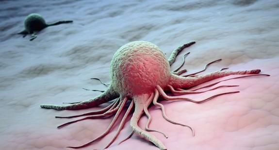 Rak naciekający – jakie są rodzaje, rokowania i metody leczenia nowotworów inwazyjnych?