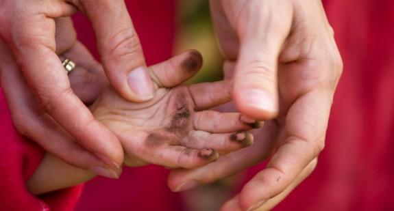 Choroba brudnych rąk – rodzaje schorzeń, objawy u dzieci, przyczyny