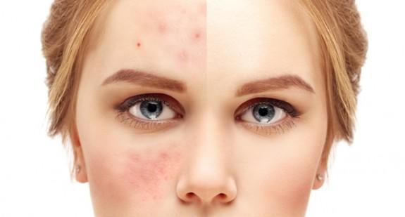 Czerwone plamy na twarzy – przyczyny i leczenie zmian chorobowych