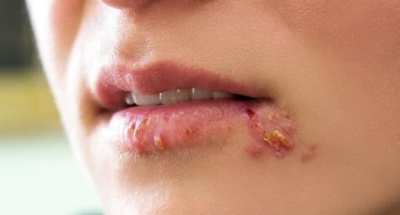 Opryszczka na ustach – przyczyny uciążliwej dolegliwości