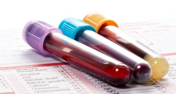 PSA – badanie z krwi: na czym polega? Normy, interpretacja wyników, cena