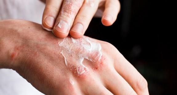 Egzema na dłoniach – leczenie domowe, przyczyny, czy jest zaraźliwa?