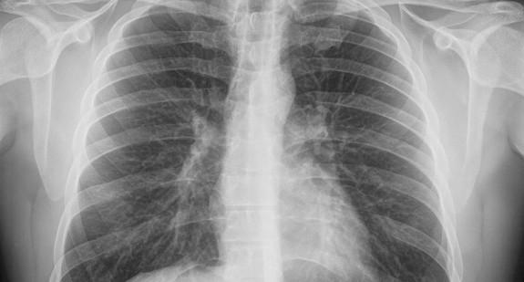 Co to jest zwapnienie w płucach? Jakie są jego przyczyny, jakie mogą być objawy i na czym polega leczenie?