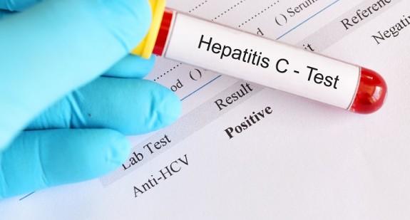 Wirus HCV – badanie przeciwciał, objawy infekcji, drogi zakażenia