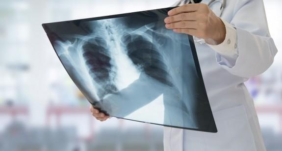 Zwłóknienie płuc idiopatyczne i pozapalne. Rozpoznanie, przyczyny