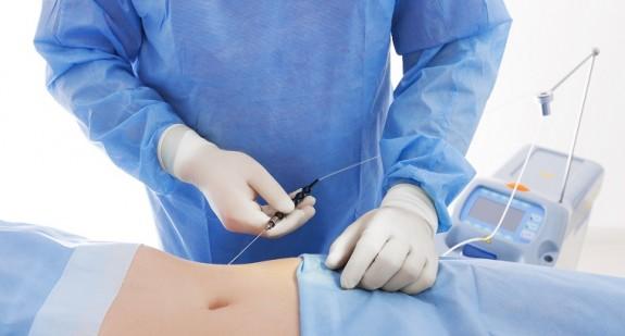 Operacje plastyczne brzucha – na czym polegają plastyka brzucha i liposukcja?