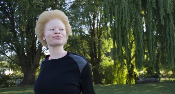 Albinizm (bielactwo) – co to jest? Jak wygląda albinos? Jakie są przyczyny choroby?