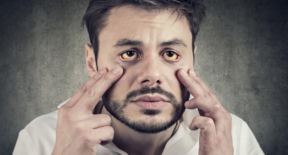 Czy żółte białka oczu oznaczają chorobę? Przyczyny zażółconych oczu