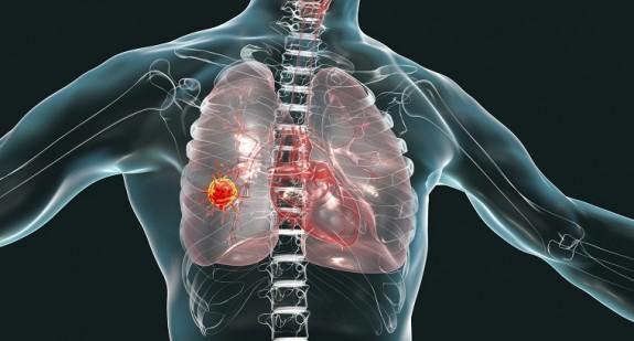 Na raka płuc coraz częściej chorują osoby niepalące. Dlaczego tak się dzieje?