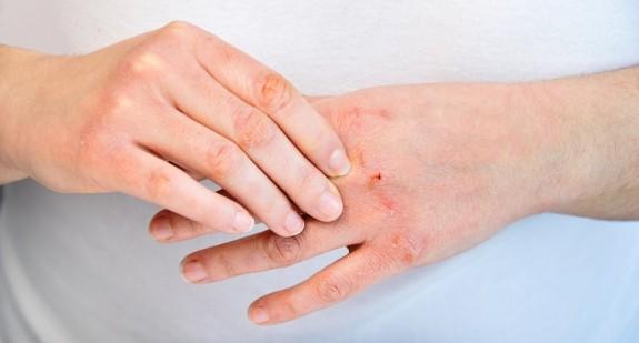 Jakie są przyczyny pękającej skóry na dłoniach?