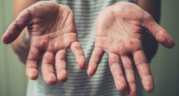 Czym jest rumień dłoniowy? W jakich chorobach występuje zaczerwienienie dłoni?