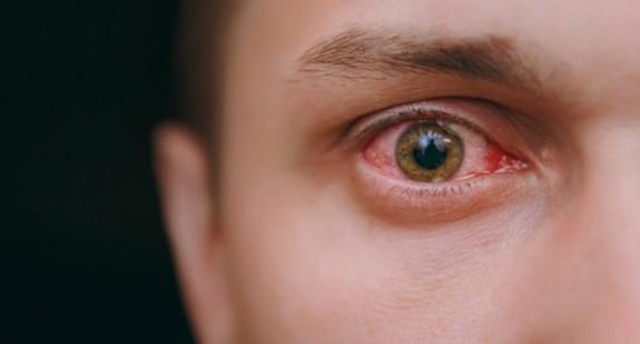 Alergiczne zapalenie spojówek – jak sobie z nim poradzić?