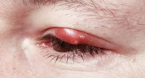 Czym jest gradówka na oku? Przyczyny, objawy i leczenie schorzenia