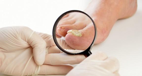Grzybica paznokci – jakie są objawy? Przyczyny, leczenie, domowe sposoby