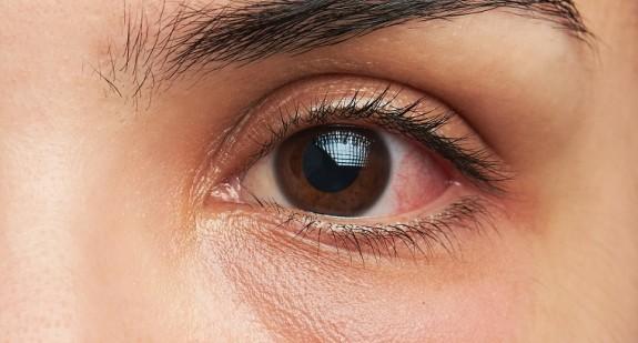 Jaglica - jakie są objawy tej choroby oczu?