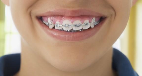 Aparat lingwalny na zęby – rodzaje, przeznaczenie, sposób leczenia