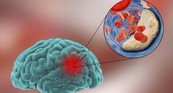 Wylew krwi do mózgu (udar krwotoczny) - jak go rozpoznać i udzielić pierwszej pomocy?