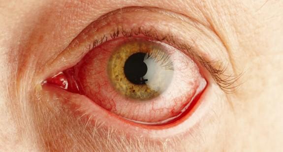 Czym jest nużeniec oka? Objawy i leczenie demodekozy ocznej