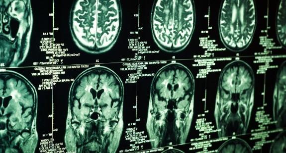 Tętniak mózgu - przyczyny, rodzaje, objawy i sposoby leczenia patologicznych zmian naczyń krwionośnych