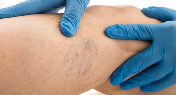 Czy laserowe zamykanie naczynek może zmniejszyć ból skóry? 