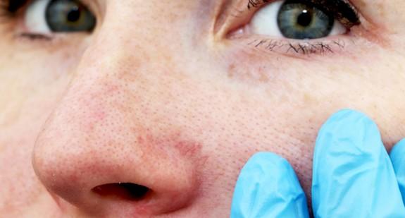 Guzowatość nosa - następstwo trądziku. Jak się objawia? 