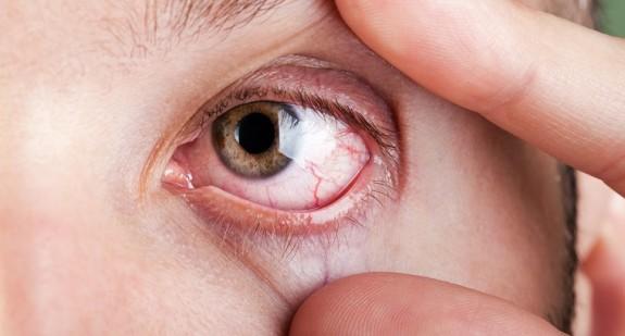 Zapalenie spojówek: rodzaje, przyczyny, objawy i sposoby leczenia choroby wzroku