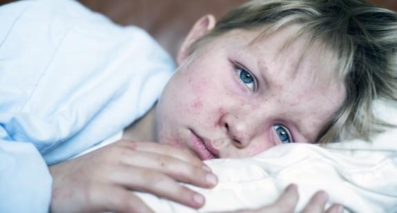 Pandemia COVID-19 może wywołać epidemię odry - ostrzegają naukowcy