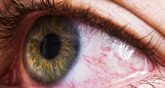 Nowotwór oka u dorosłych i dzieci – objawy, przyczyny i leczenie