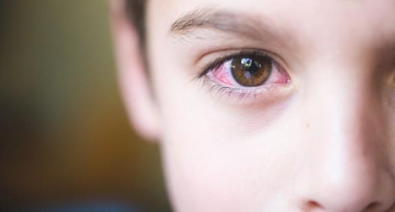 Czerwone oczy u dziecka - jakie są tego przyczyny? 