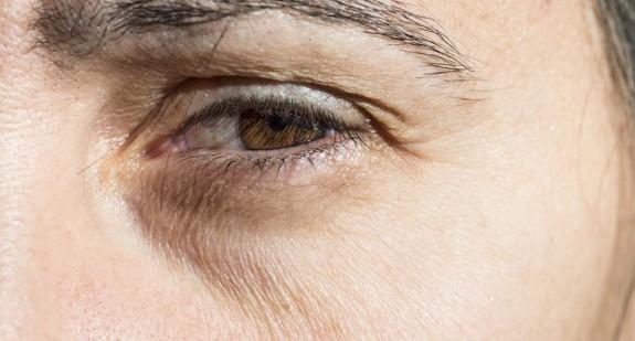 Opuchnięte oczy – przyczyny, co oznaczają i jakie są skuteczne sposoby leczenia?