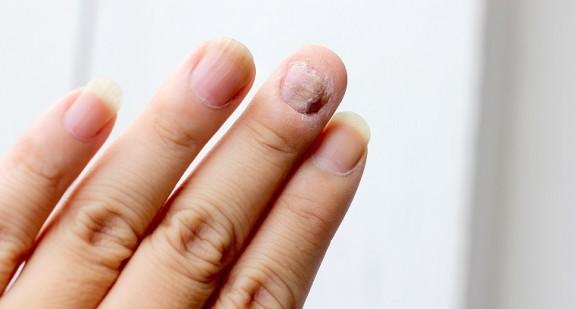 Krwiak pod paznokciem – przyczyny powstania. Jak wygląda krwiak pod paznokciem? Diagnostyka, leczenie