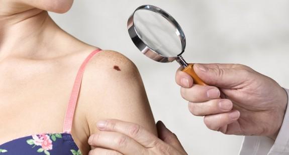 Rak skóry to nie tylko czerniak. Ruszyła kampania Rak UV, która ma zawrócić uwagę na raka kolczystokomórkowego skóry 