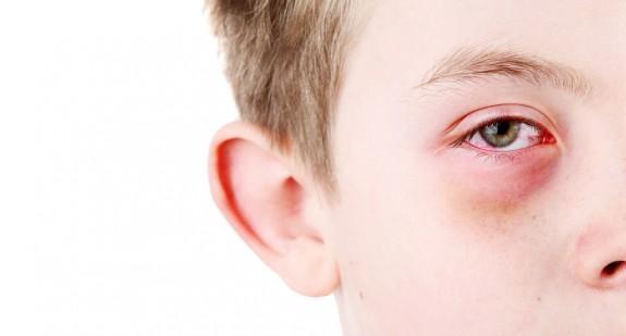 Przekrwione oczy u dziecka i dorosłego –­ jakie są najczęstsze przyczyny? Jak łagodzić objawy?