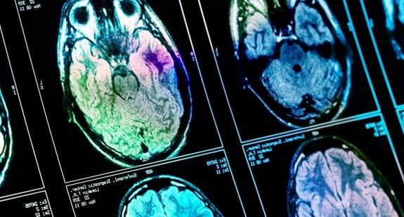 Jak objawia się rak mózgu? Rozpoznanie i leczenie choroby