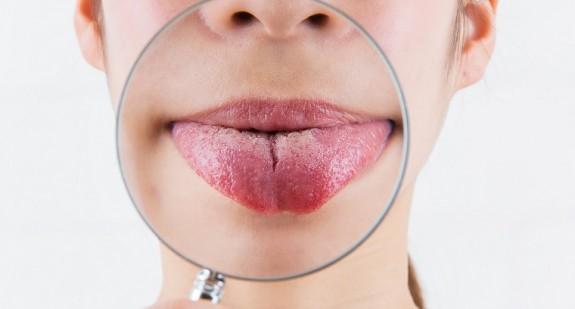Objawy raka języka, jego przyczyny i metody leczenia