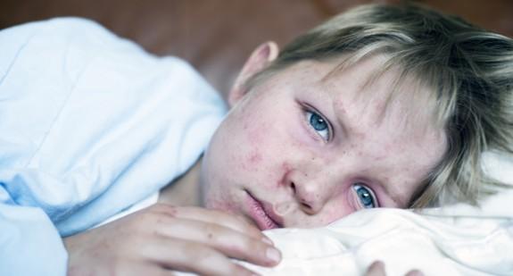 Różyczka – leczenie zakaźnej choroby wirusowej u dzieci i dorosłych