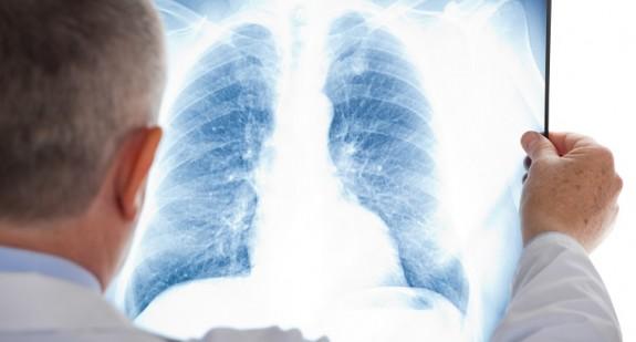 Czy rozedma płuc jest śmiertelna? Jak rozpoznać objawy?