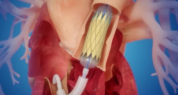 Jak wygląda przezskórna implantacja zastawki serca u dzieci?