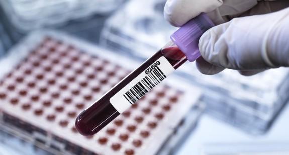 Czy zwykłe badanie krwi pomoże wykryć ryzyko zgonu z powodu COVID-19? 