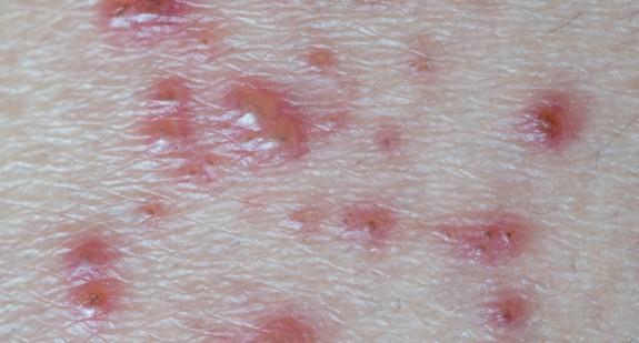 Stan zapalny skóry o podłożu bakteryjnym, grzybiczym i wirusowym