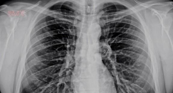 Rak płuc – jak skutecznie go leczyć? Jakie mogą być pierwsze objawy choroby? 