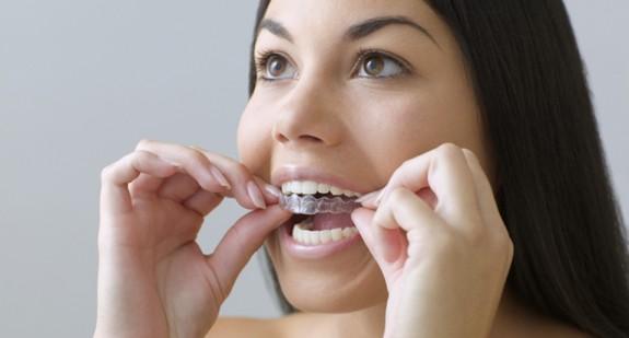 Na czym polega wybielanie zębów metodą nakładkową? Efekty i czas trwania zabiegów